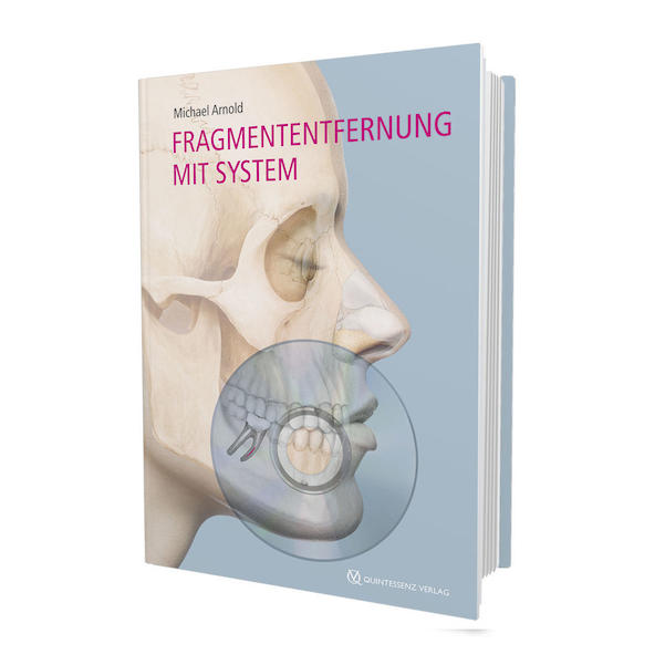 Fragmententfernung mit System