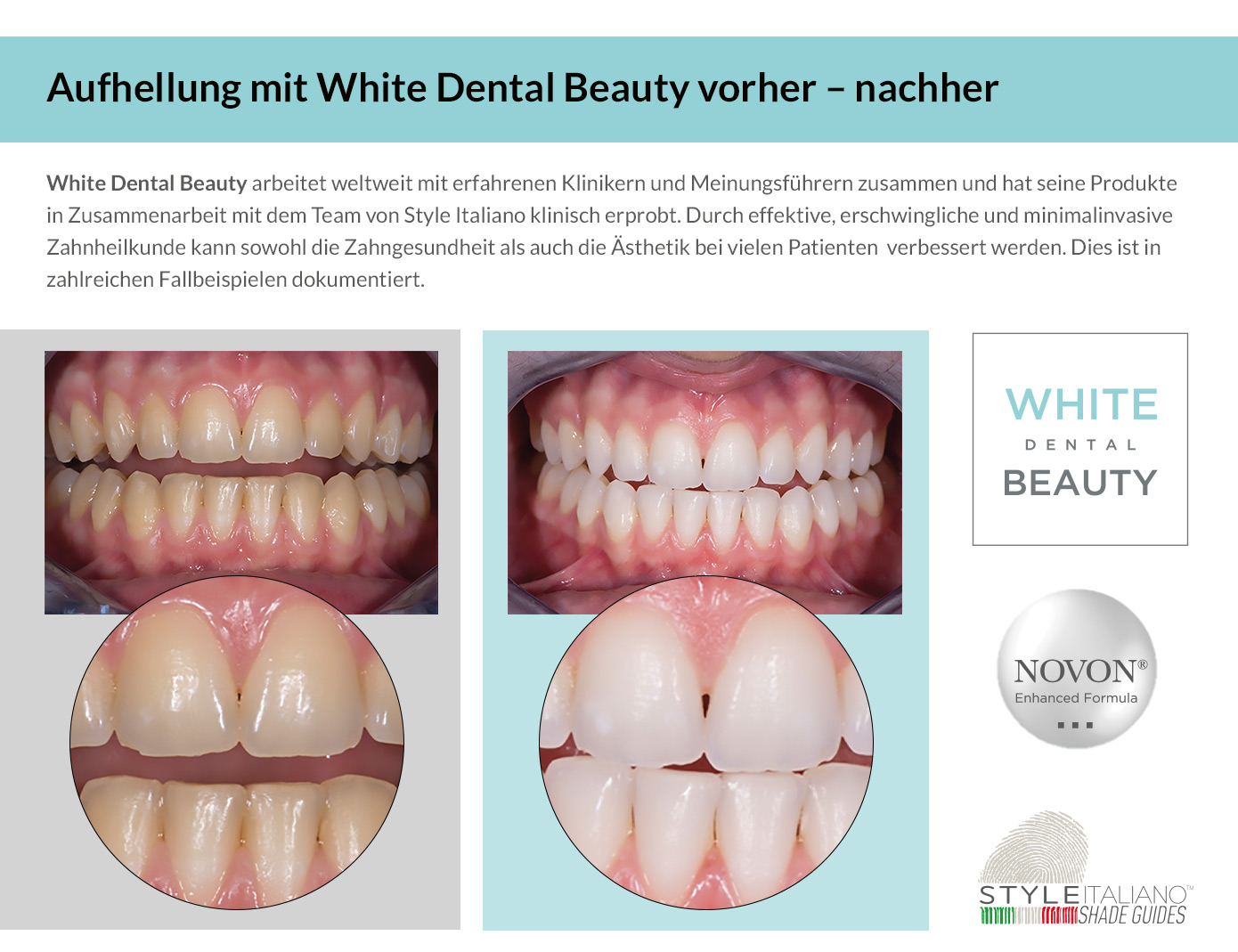 WDB-LWhite-Dental-Beauty Vorher - Nacher 